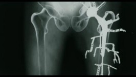 Metalosis Maligna Metalosis Maligna