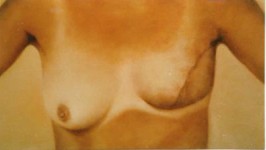 Borst reconstructie 2 Borst reconstructie 2